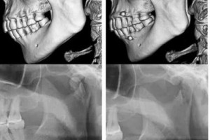 整形科普：可吸收钉板在下颌骨髁突骨折中的应用