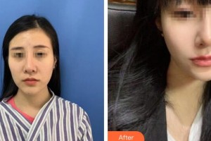 广州美莱医疗美容医院彭静整形价格表附多方面部埋线提升案例展示