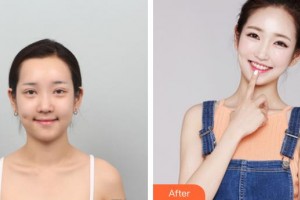 上海宏康医院整形美容中心宋东明整形价格表附	鼻部手术整形案例展示