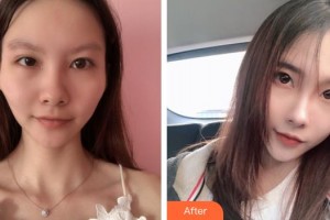 上海玛丽医院整形美容中心杨月秀整形价格表附颧骨颧弓整形案例展示