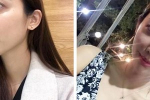 上海格莱美整形美容医院孙笠整形价格表附颧骨内推案例展示