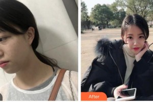 上海复丽医疗美容门诊部庄贺婷整形价格表附超激光美肤激光案例展示