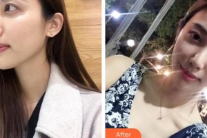 济南婵之媛医疗整形美容医院洪承业整形价格表附创可贴面部吸脂瘦脸案例展示