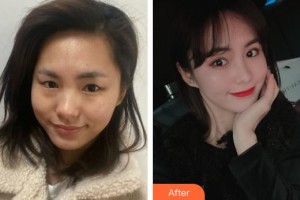 上海港华医院浦东分院（悦容医疗美容诊所）罗文婷整形价格表附鼻部综合案例展示