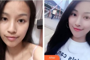 成都恒博医院整形美容中心白振华整形价格表附鼻部综合案例展示