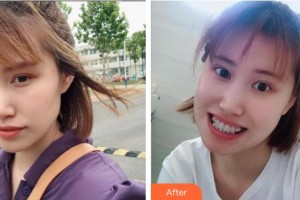 福州美莱华美美容医院邓诚整形价格表附金属托槽牙齿矫正案例展示