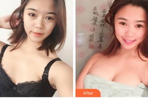 福州曙光整形美容医院冯光珍整形价格表附浓缩丰胸真实案例展示