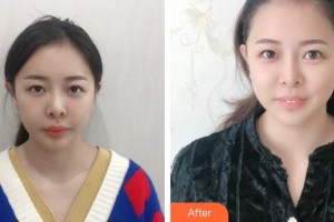 福州海峡美容医院蓝绍梓整形价格表附激光美肤激光祛黑眼圈案例展示