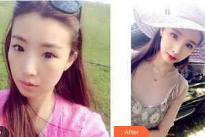 福州隆美尔整形美容医院郭永年整形价格表附鼻部手术案例展示