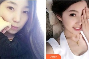 福州美莱华美美容医院刘欣整形价格表附时代天使矫正案例展示