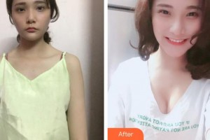 厦门莫琳娜医疗美容门诊部叶佐诚整形价格表附丰胸案例展示