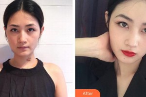 莆田明韩女人花整形美容诊所吴建超整形价格表附增生疤痕案例展示