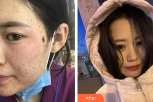 合肥华美整形美容医院赵晶晶整形价格表附激光美肤激光案例展示