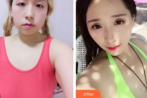 合肥恒美整形医院丁彩莲主管护师整形价格表附假体隆胸整形案例展示