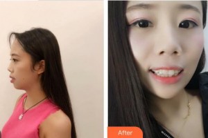 合肥拜博口腔医院李铜美整形价格表附牙齿隐形矫正案例展示