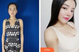 芜湖东方美莱坞医疗美容门诊部崔宁波整形价格表附假体隆胸案例展示