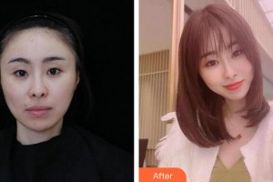 蚌埠美莱坞整形美容医院赵士骏整形价格表附胶原蛋白除皱案例展示