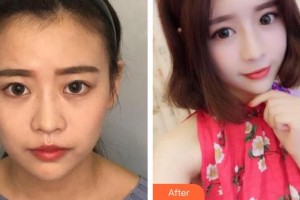 蚌埠靓妹医疗美容门诊部叶丽琴整形价格表附热玛吉案例展示