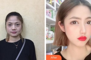 杭州爱琴海医疗美容医院李华整形价格表附埋线提升案例展示