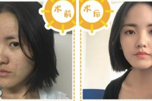 宁波美莱整形美容医院李亮整形价格表附埋线提升案例展示