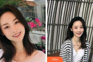 宁波美莱整形美容医院田俊整形价格表附金属托槽矫正案例展示