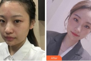 宁波市妇女儿童医院医学美容科黄应整形价格表附激光祛斑案例展示