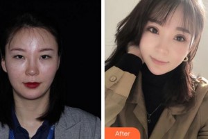 宁波美仁整形美容医院李英大整形价格表附眼部综合案例展示