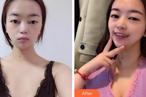 温州雅美姬整形美容医院王公望整形价格表附自体脂肪隆胸案例展示