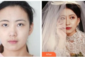 绍兴华美整形美容医院徐荣俊整形价格表附热玛吉案例展示