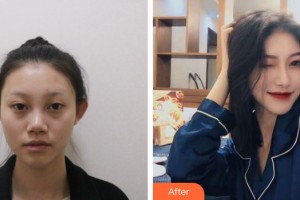 南宁市医学美容诊所卢志刚整形价格表附隆鼻手术案例展示