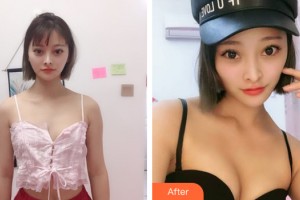 武汉一美整形美容医院严志整形价格表附自体脂肪丰胸案例展示