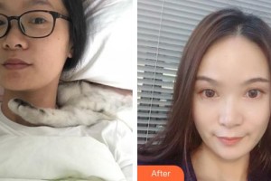 保定华仁皮肤病医院激光美容中心刘敬整形价格表附埋线提升案例展示