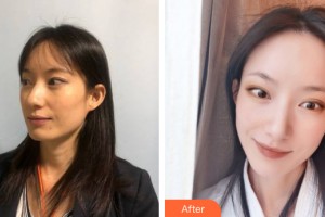 中山大学附属第三医院整形美容中心朱蕾整形价格表附皮肤美容案例展示