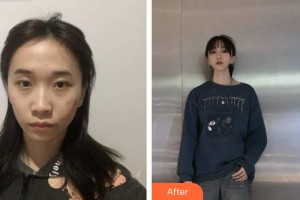 荆州华美整形美容医院董岩岩整形价格表附微创疤痕修复案例展示