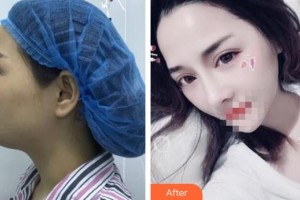 永安茜茜科美医疗美容门诊部黄祖根整形价格表附鼻部综合案例展示